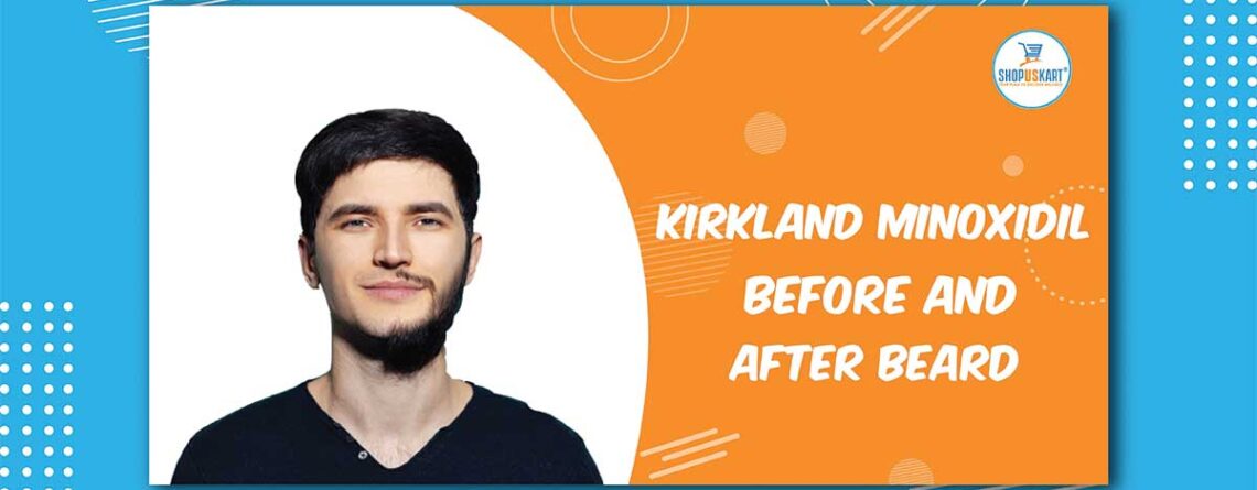 Kirkland Minoxidil before and after beard