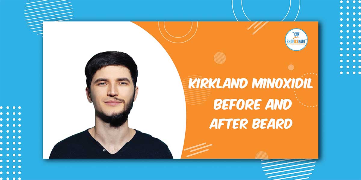 Kirkland Minoxidil before and after beard