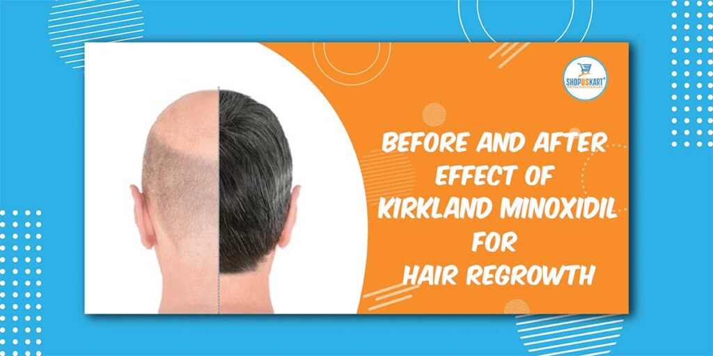 Before And After Effect Of Kirkland Minoxidil For Hair Regrowth