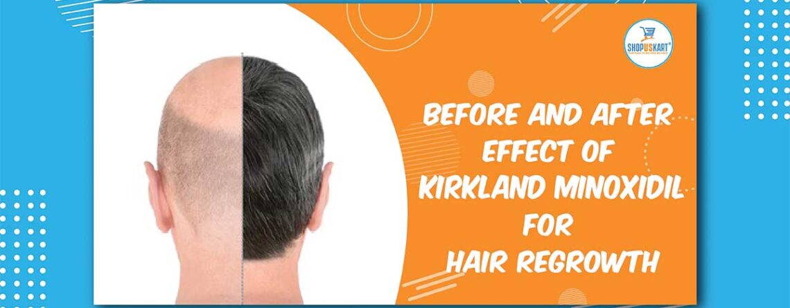 Before and after effect of Kirkland Minoxidil for hair Regrowth