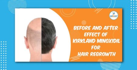 Before and after effect of Kirkland Minoxidil for hair Regrowth