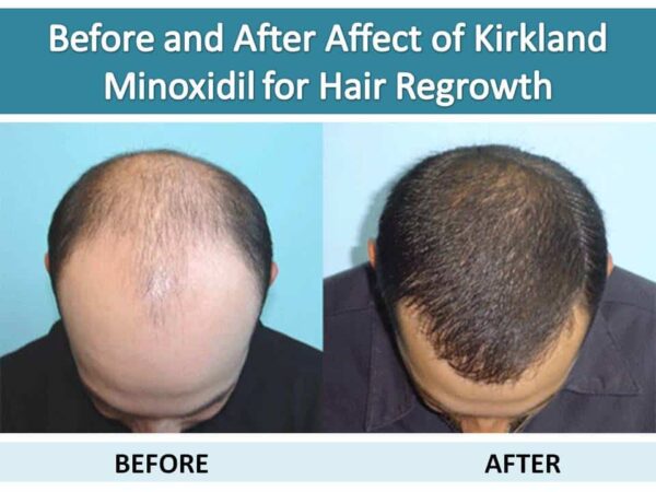 Before and after effect of Kirkland minoxidil for hair Regrowth ...