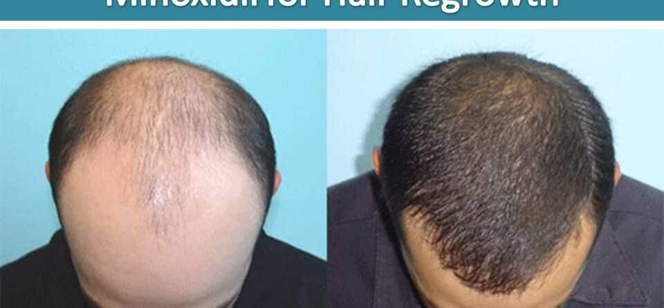 Featured image of post Moisturize Before Or After Minoxidil Putting lotion on before then will likely interfere with minox s effectiveness since you probably won t