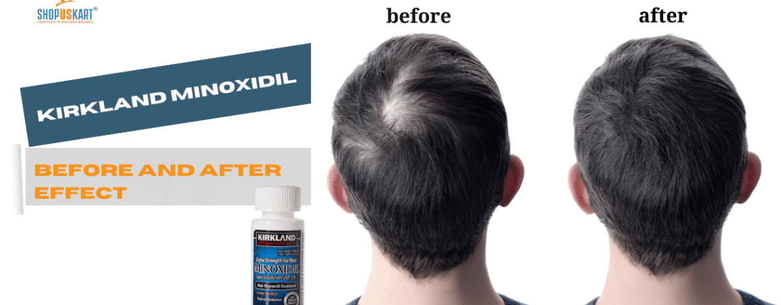Before and after effect of Kirkland Minoxidil