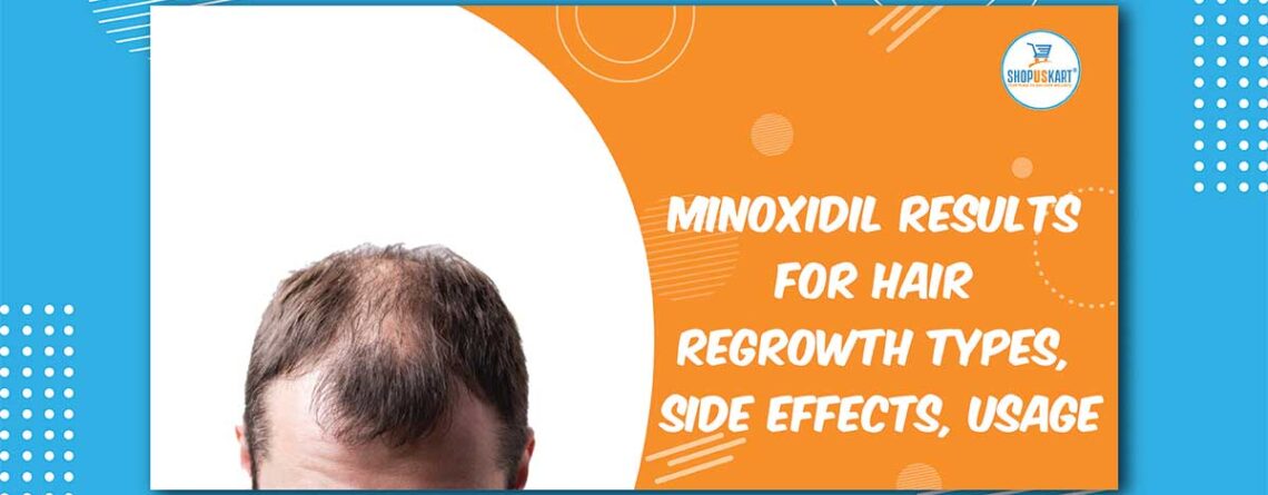 Minoxidil Results for Hair Regrowth Types, side effects, usage
