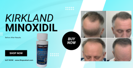 Kirkland Minoxidil Before After Results