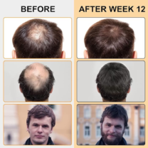 Thinning Hair - Before Using Hair Growth Foam